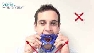 Dental Monitoring How to put cheek retractor [upl. by Eisso]