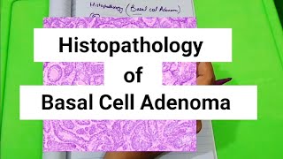 Histopathology of Basal cell Adenoma Monomorphic Adenoma [upl. by Atsyrk]