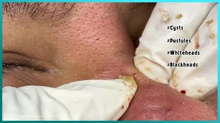 Big Cystic Acne Blackheads Extraction Blackheads amp Milia Whiteheads Removal Pimple Popping [upl. by Romeyn983]