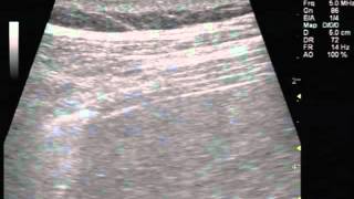 Ultrasonography of Normal and Paralyzed Diaphragms [upl. by Willing551]