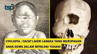 ENG SUB Cyclopia A rare birth defect similar to the Children of Gods in Greek Mythology [upl. by Ailalue]