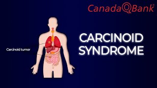 Carcinoid Syndrome [upl. by Brynna353]