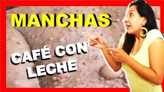 ▷ Neurofibromatosis ✅ MANCHAS CAFÉ CON LECHE en niños Dermatología infantil [upl. by Aralc940]