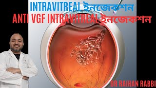 Intravitreal ইনজেকশন  Avastin injection  An intravitreal injection  AntiVEGF treatment [upl. by Asiral]