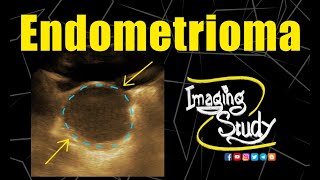 Endometrioma  Chocolate Cyst  Ultrasound  Doppler  Case 148 [upl. by Cornia]