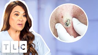 Top 5 Pimple Popping Moments From A 55YearOld Blackhead To Oozing Fistulas [upl. by Adaj]