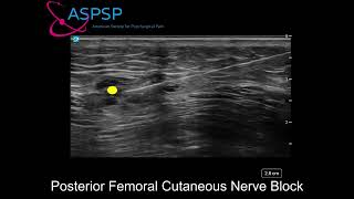 Posterior Femoral Cutaneous Nerve Block [upl. by Mcgraw]