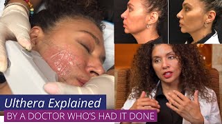 Ulthera aka Ultherapy  Explained by a Doctor whos had Ulthera herself [upl. by Betteann]