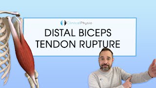 Distal Biceps Tendon Rupture  Expert Physio Review [upl. by Yelsnit]