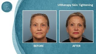 Ultherapy ultrasound painless facelift Dr Melanie Palm San Diego [upl. by Inaluahek423]