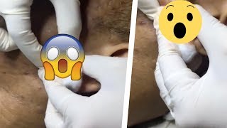 Enormous Zit Popping Caught on Camera [upl. by Adeuga]