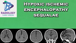 Hypoxic ischemic encephalopathy sequalae [upl. by Therine811]