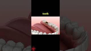 Periostitis tooth  Lump on Gum Above Tooth dentist dentalwellness [upl. by Eilrahc905]