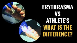 Erythrasma vs Athletes Foot  What is the difference [upl. by Yelraf]