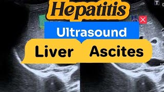 Hepatic Parenchymal Disease  Hepatitis  Splenomegaly  Ascites Ultrasound [upl. by Ahsoym]