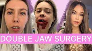 What Its Really Like Having Jaw Surgery [upl. by Monte]