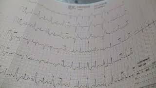 Rate dependant LBBB in Stress ECG Test [upl. by Gerek]