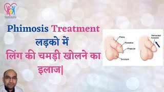 Treatment of Phimosis Cream for Phimosis Home remedy for Phimosis [upl. by Nainatrad]