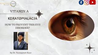 Keratomalacia  VITAMIN A  EYE CARE  How to Prevent Vitamin A Deficiency [upl. by Tilney275]