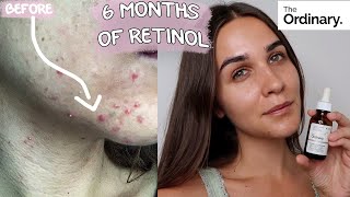 RETINOL CLEARED MY ACNE  BEFORE amp AFTER  6 months update  THE ORDINARY [upl. by Roswald]