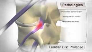 Stages of Lumbar Disc Herniation Bulging disc L4L5S1 Herniated Disc Types Disc Protrusion [upl. by Stila60]