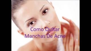 Como Quitar Manchas De Acne Rapidamente [upl. by Inesita437]