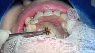 Placement procedure of Lim plate system with a preformed lever [upl. by Ociral]