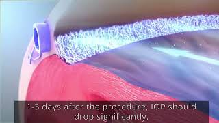 What is Selective Laser Trabeculoplasty SLT SLT laser treatment for glaucoma [upl. by Yrrep]