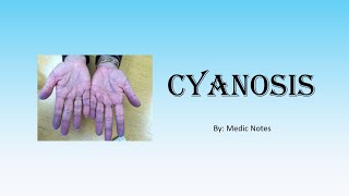 Central and peripheral cyanosis  causes pathophysiology [upl. by Oinotnanauj930]