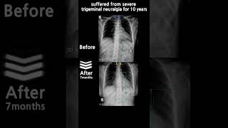 suffered from severe trigeminal neuralgia for 10 years  58 yo  Female  korea [upl. by Leira54]