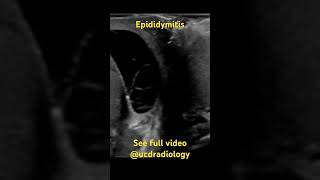 Epididymitis radiologist radiology ultrasound medicine medicalschool [upl. by Harvison]