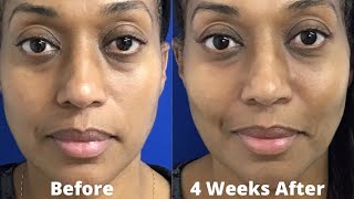 Dermal Filler Under Eyes and Cheek Restoration  Tear Trough [upl. by Ainigriv]