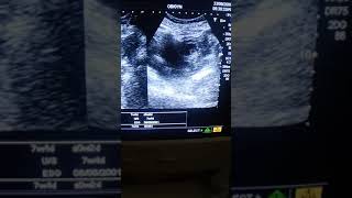 left adnexal ectopic pregnancy of 7 weeks by Dr Fatima [upl. by Gora]