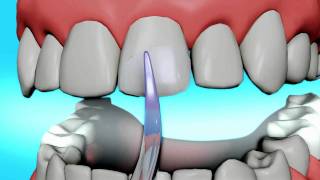 Dental Bonding Video  Tooth Bonding [upl. by Hsakaa]