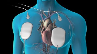 Cardioversion for Atrial Fibrillation [upl. by Rebane]