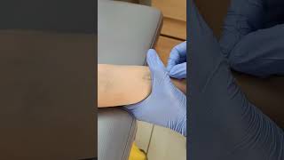 Mantoux Tuberculin Test  PATHOLOGY life sterlingaccurisdiagnostics [upl. by Tracie]