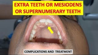 SUPERNUMERARY TEETH MESIODENS EXTRA TEETH COMPLICATIONS AND TREATMENT dentalcafe4331 [upl. by Gnol]