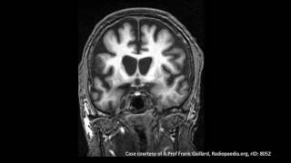 Huntingtons Disease [upl. by Giliane]