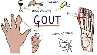 Gout Visual Explanation for Students [upl. by Hun]