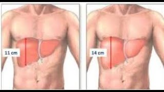 Semiologie digestive  Hepatomegalie [upl. by Oiram48]