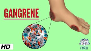 General Pathology lecture5  Gangrene hindi Dry wet and gas gangrene [upl. by Morrell]