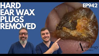 HARD EAR WAX PLUGS REMOVED  EP942 [upl. by Atahs]