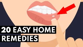 How To Get Rid Of Canker Sores FAST [upl. by Noyar627]