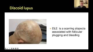 Scarring Alopecia Summit Other Types Breakout Room [upl. by Jourdan]