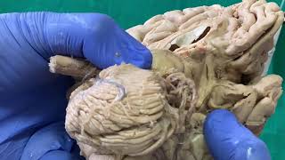 Dissection  Sulci amp Gyri on inferior surface of brain [upl. by Asaret421]