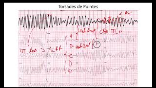 Torsades de Pointes EKG [upl. by Adlecirg]