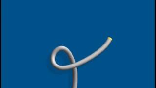 alpha loop in colonoscopy [upl. by Nomad]