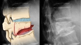 Vertebral Compression Fracture Explained by a Top Pain Physician in Las Vegas Nevada [upl. by Aseeram]