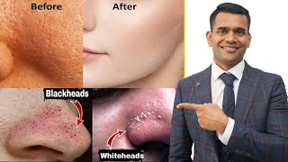 Blackheads Whiteheads Open Pores 100  Working Home Remedy  How To Shrink Pores [upl. by Nakashima]