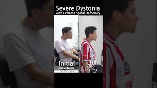 a Severe Dystonia Patient with Extreme Spinal Deformity [upl. by Eudoca290]